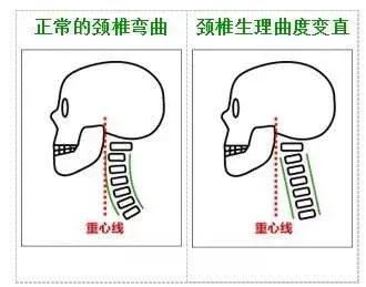颈椎生理曲度变直用什么枕头图片,颈椎生理曲度变直可以睡u型枕吗