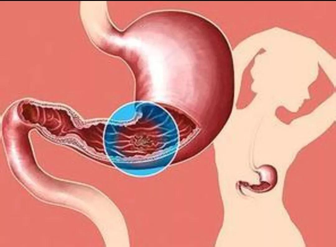 胃粘膜受损不治疗有什么后果,胃黏膜受损怎么好得快呢