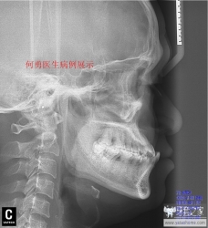 正畸医生如何指定方案的,正畸医生怎么说