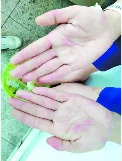 19岁女孩连续吃鱼,女孩因吃鱼身体发生变异