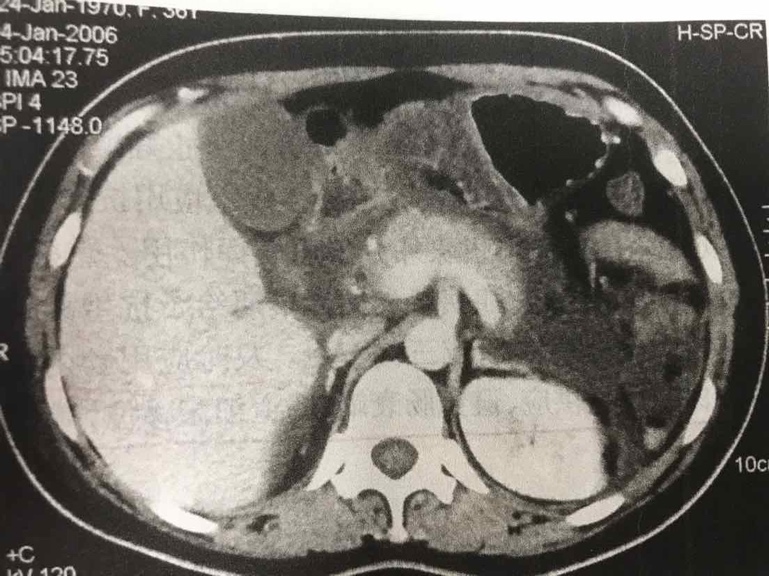 妊娠期胰腺炎常见病因,孕期胰腺炎如何饮食