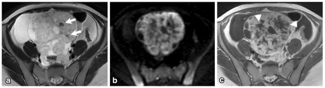 卵巢实性为主肿瘤，这13种你都想到了吗？