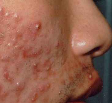 痘痘是如何形成的,痘痘是怎么形成的