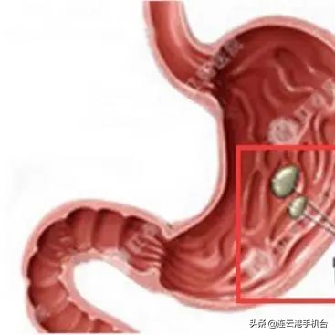 男子吃柿饼抢救,一男子吃橘子进医院