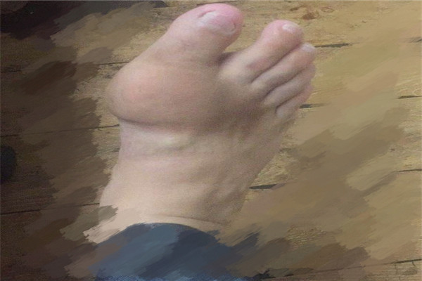 痛风发作脚痛如何缓解,急性痛风脚疼怎么快速缓解