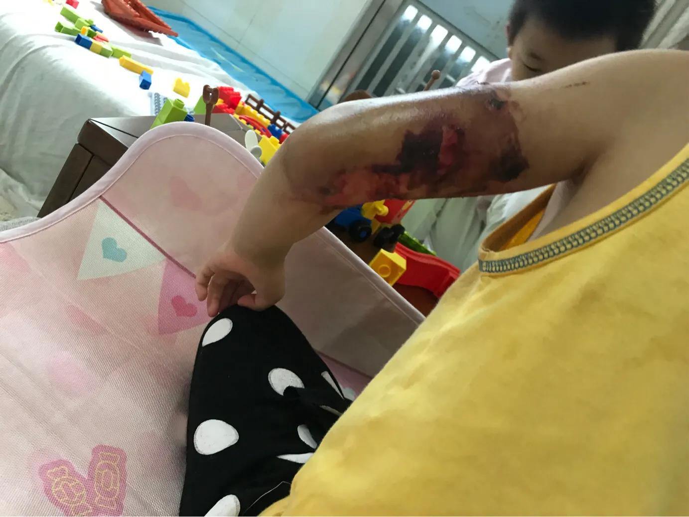 孩子大面积烫伤治疗流程,记录女儿被烫伤到治疗全过程