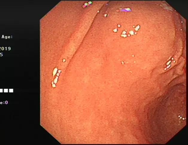 消化内镜发展现状,上消化道超声内镜临床应用