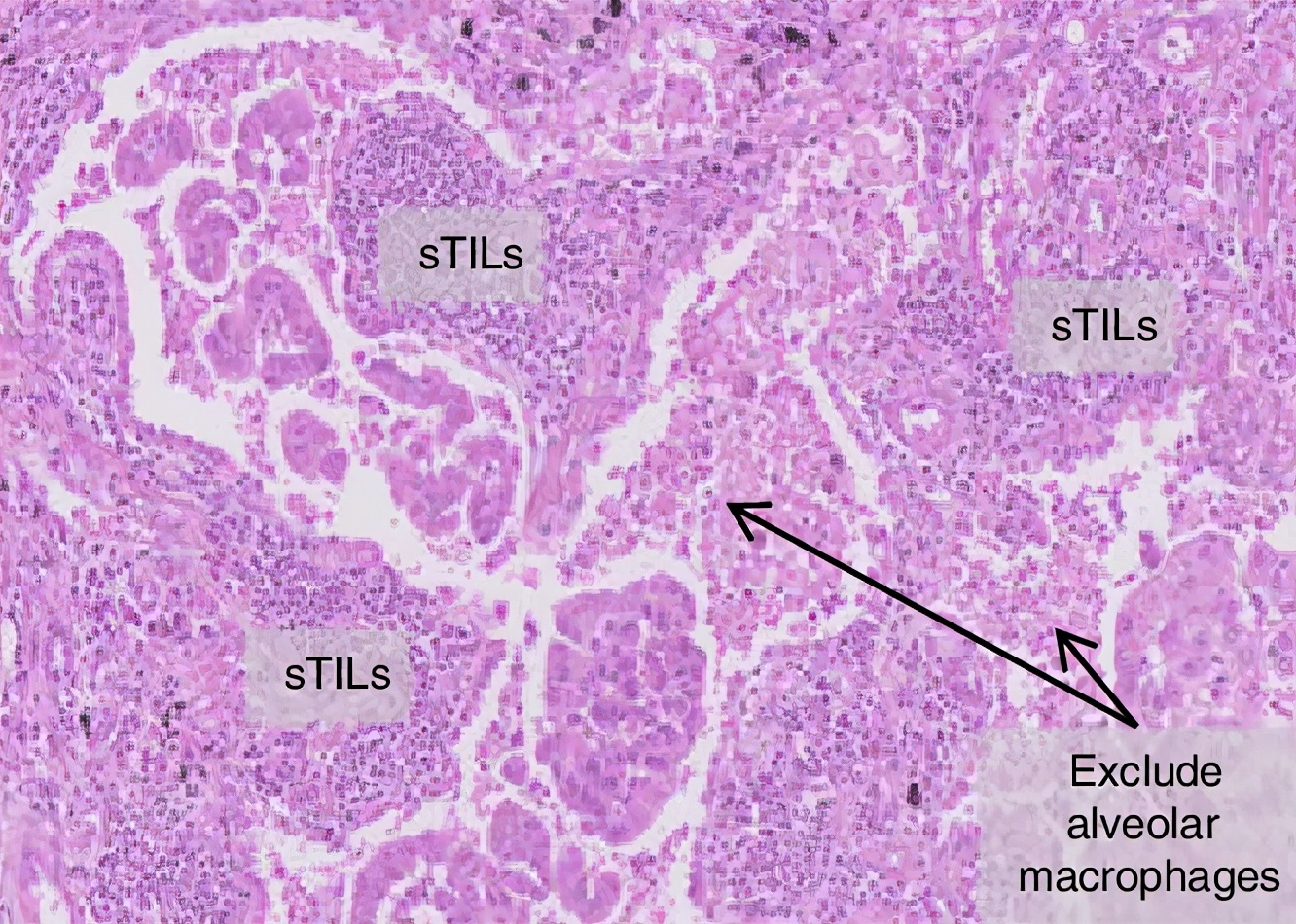 更好的免疫治疗来啦！逆转“PD-1无效”，肺癌治愈可期