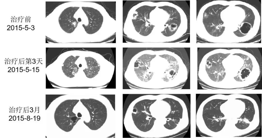 PCCM直播丨中年装修工人双肺多发空洞，奴卡菌＋曲霉菌如何治疗？