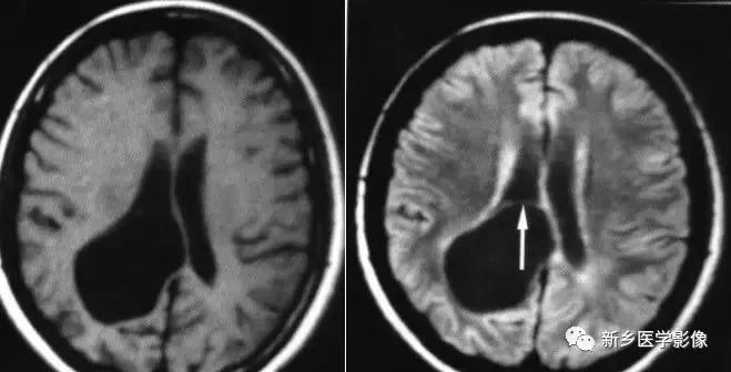 影像学脑室扩大,脑室显大怎么理解