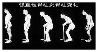 强直性脊柱炎需要哪些锻炼方法,强直性脊柱炎有哪些锻炼的方法