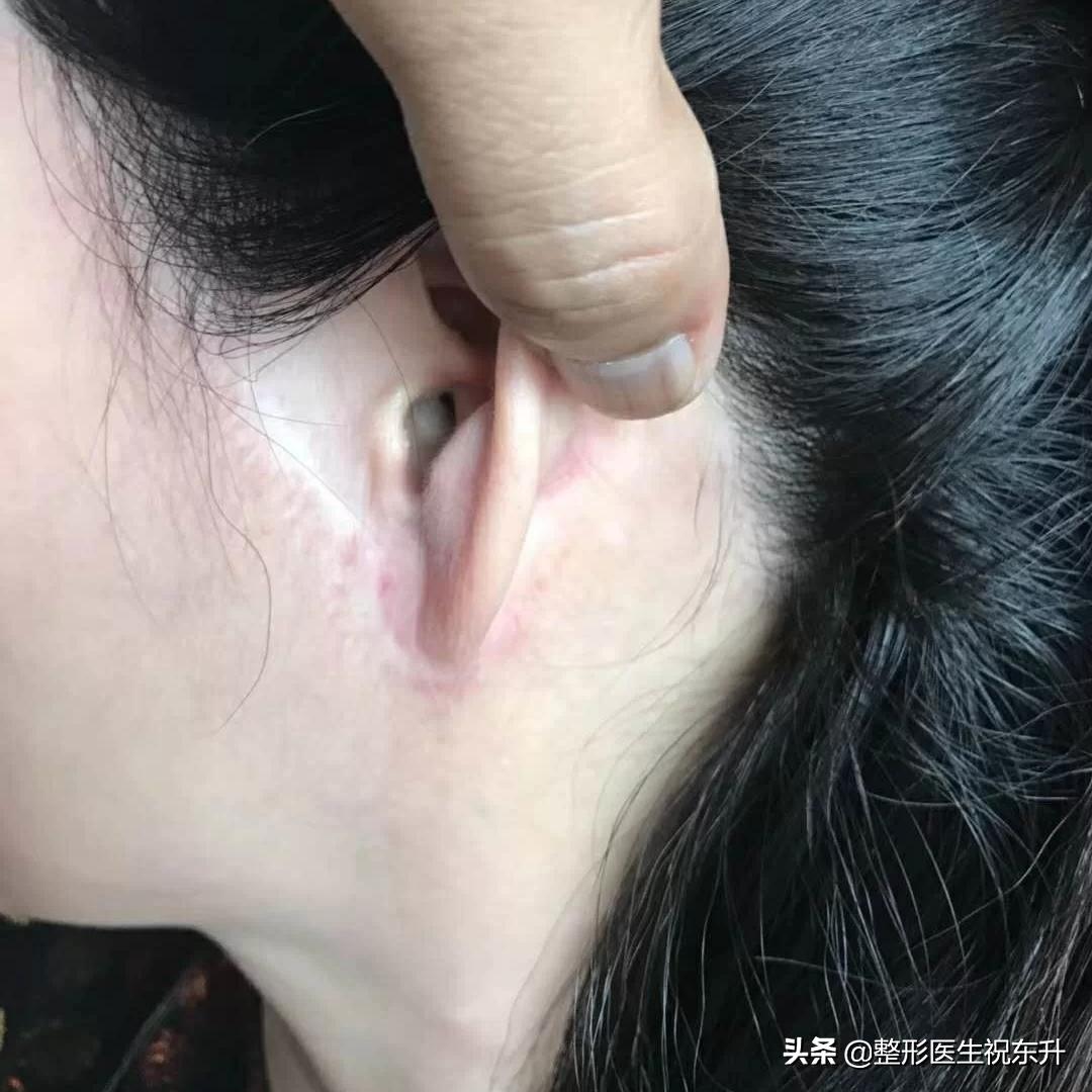 拉皮手术后的真实面部整形失败,脸部整形美容后遗症