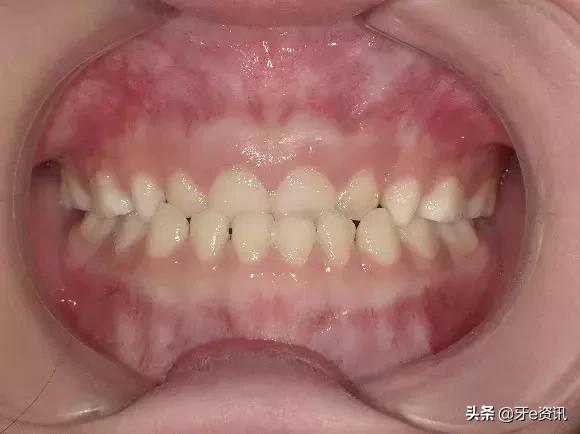 狗狗乳牙地包天怎么办,儿童乳牙地包天怎么办