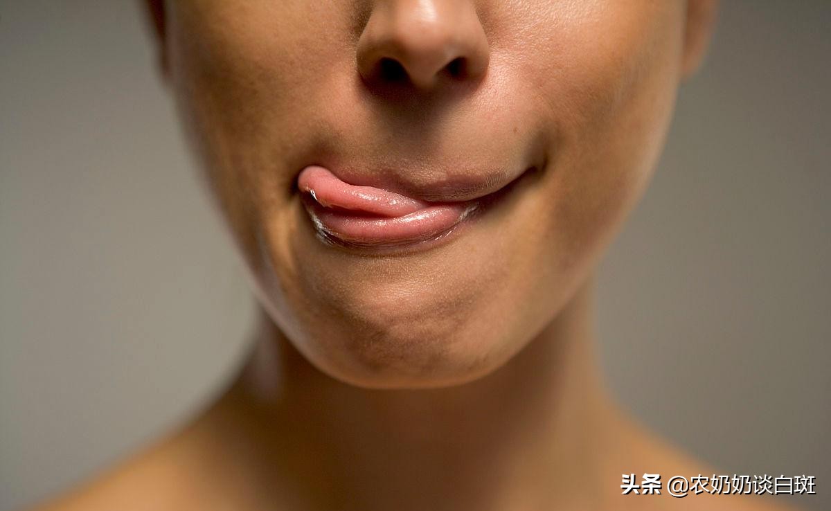 舔一舔:女子变烈焰红唇?白癜风在嘴巴上来回跳跃