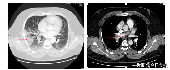 大学生熬夜打游戏肺栓塞,大学生通宵打游戏心梗