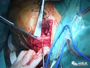 肩锁关节脱位手术后多久可以喝酒,肩锁关节脱位钢板内固定步骤记录