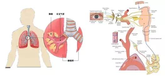 中央型肺癌和周围型肺癌的ct区别,中央型肺癌CT和支气管镜能看出吗