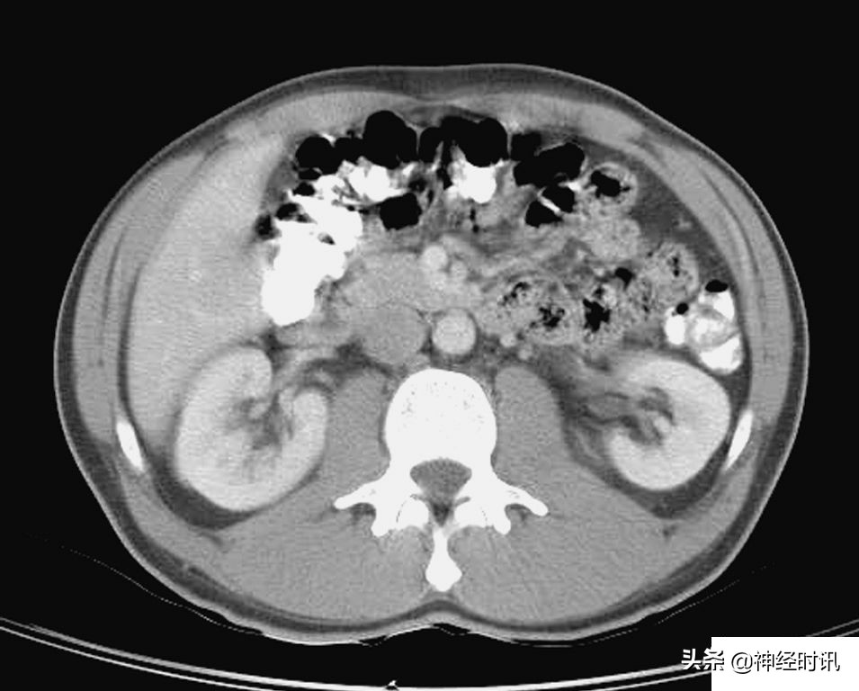 肾脏输尿管膀胱前列腺结构,肾输尿管膀胱解剖示意图