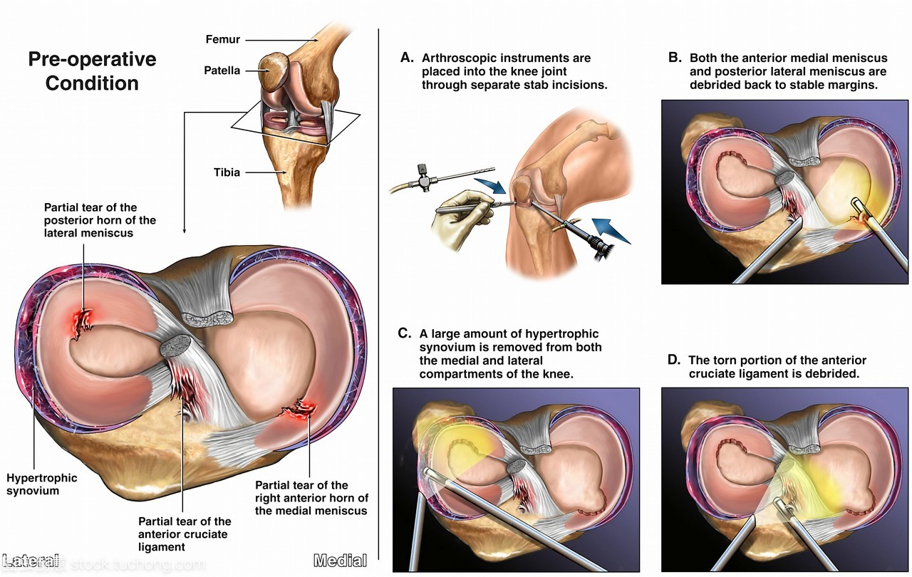 膝盖痛半月板疼怎么办缓解,膝关节疼痛半月板损伤怎么治疗