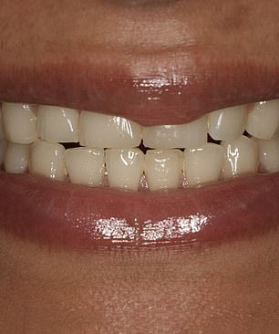 长期过度饮酒对牙齿的危害,长期吸烟喝酒的牙齿长什么样子