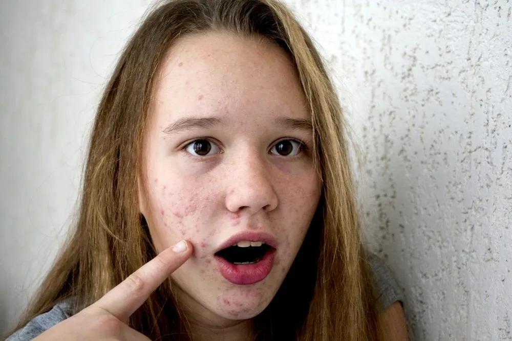 光动力治疗后脓包痘几天恢复,中重度痤疮外用药