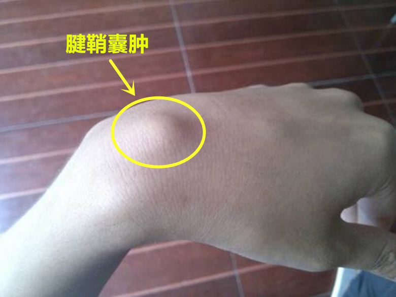 腱鞘囊肿怎样快速消除小妙招,腱鞘囊肿消除小妙招小视频