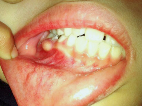 牙龈长脓包疼痛如何缓解,牙龈长了个脓包如何快速止痛