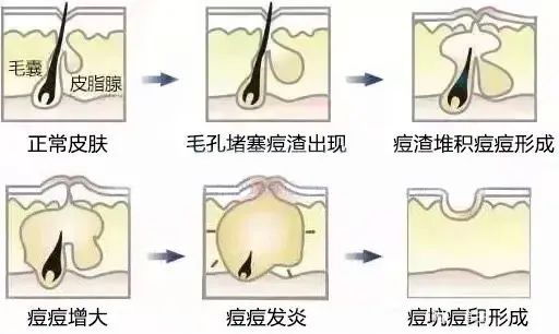 痘痘好了之后痘印怎么去除,痘痘留下的痘印痘坑怎么修复