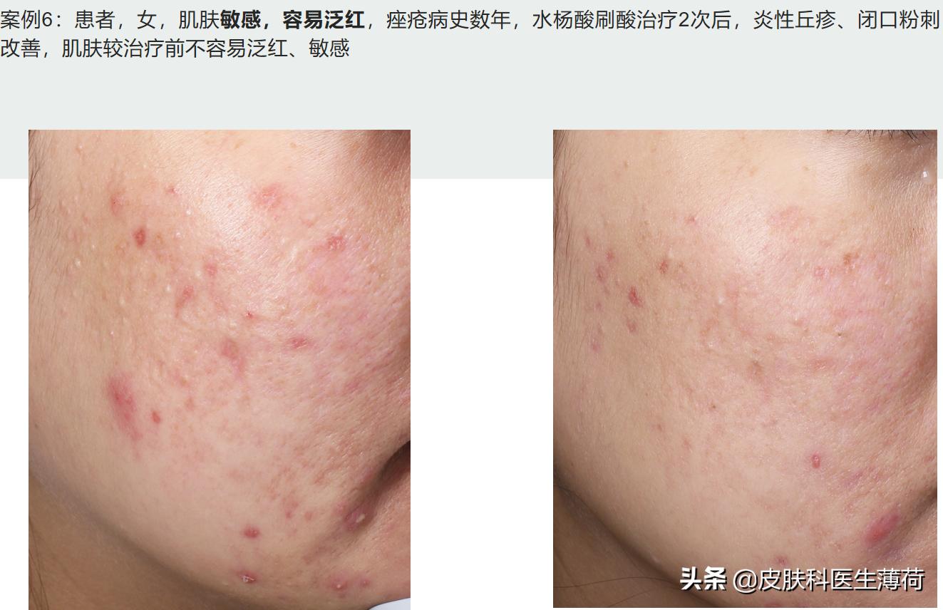 水杨酸精华果酸去闭口粉刺,刷酸去黑头好物推荐