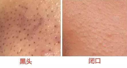 去黑头粉刺的最有效最简单的方法,你不能不知道的去粉刺秘籍