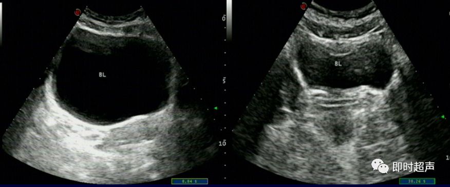 膀胱超声图解大全,膀胱超声解剖及常见病变超声表现