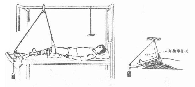29岁右股骨颈骨折恢复最佳的方法,82老人股骨头摔骨折了该怎样治疗