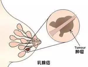 乳腺硬化性腺病易误诊为哪种癌,乳腺包块长得快是什么原因