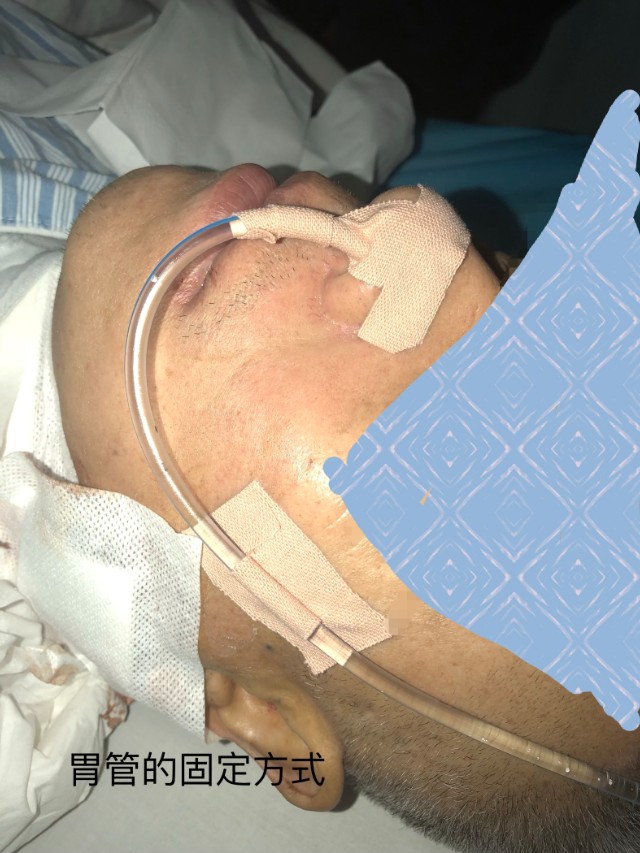 喉癌应了解哪些病史,癌症患者家属必须知道的这5个点