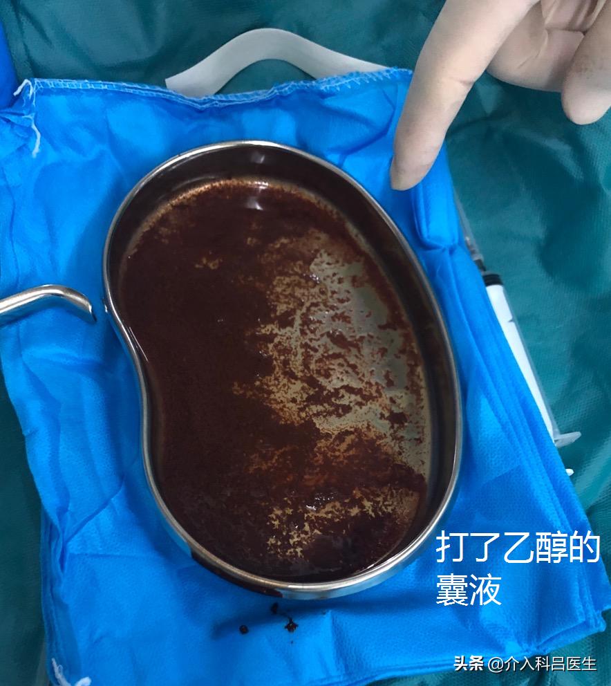 河南卵巢囊肿介入治疗哪家好,一根针治疗卵巢囊肿过程