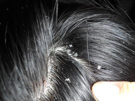 一招帮你解决头皮问题,头皮常见的问题有哪些