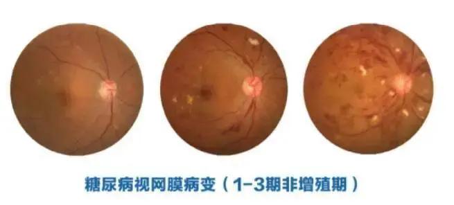 老人视力模糊眼睛失明怎么救治,八旬老人双目失明怎么办