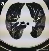 新型冠状病毒感染的肺炎患者肺部影像学改变