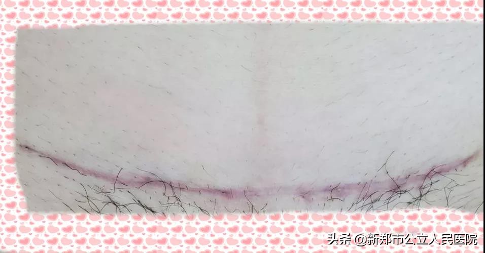 剖腹产双眼皮,剖腹产抬屁股避免压肚子