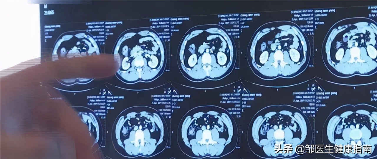 28岁小伙直肠癌晚期,23岁小伙直肠癌