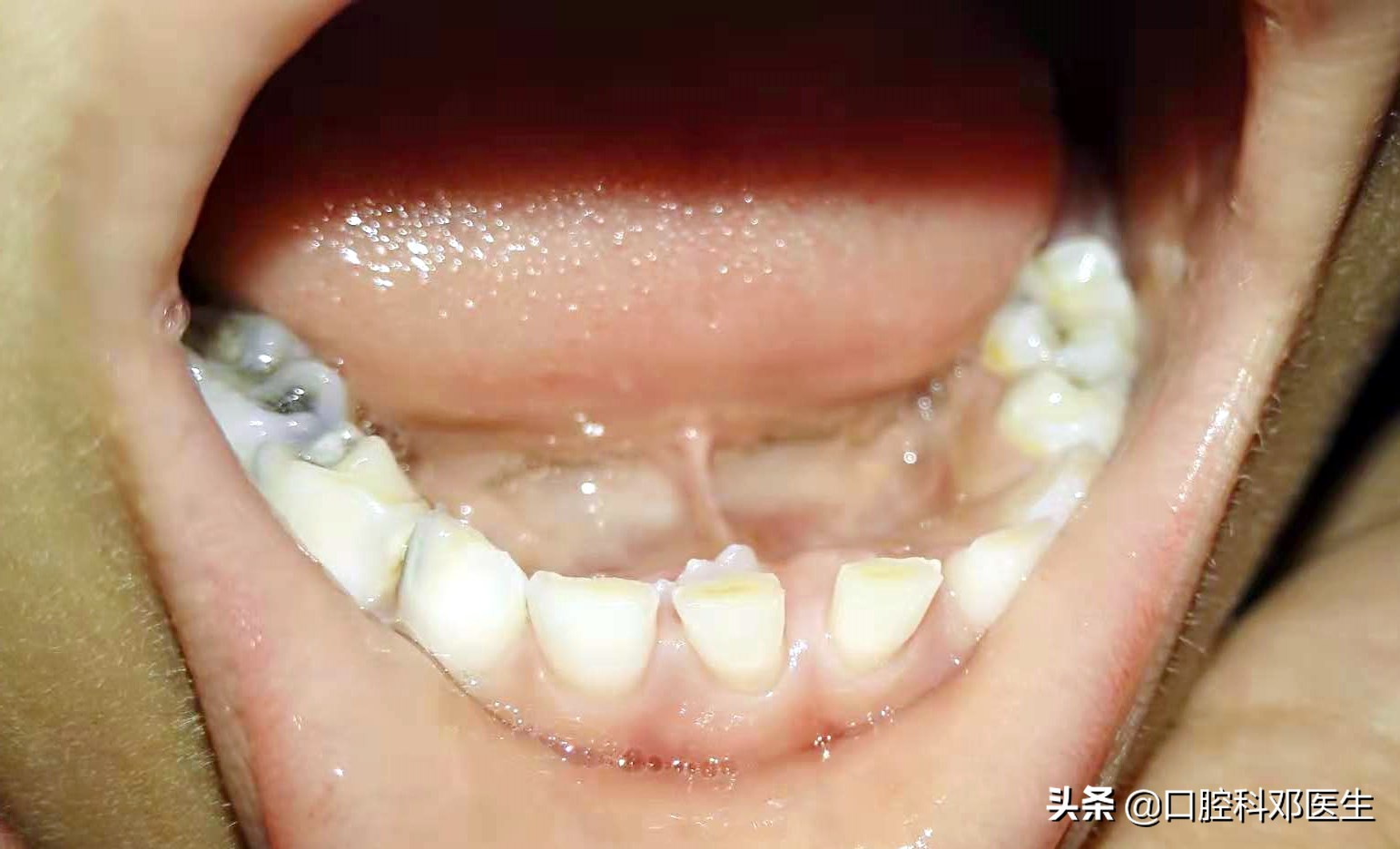 孩子换牙换掉的牙怎么处理,孩子换牙要不要矫正