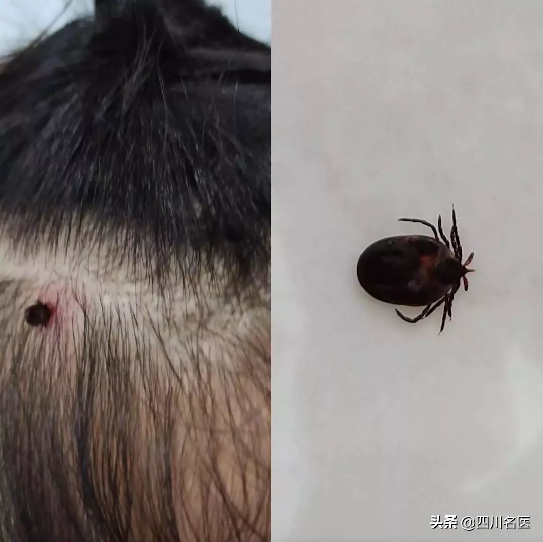 夺命虫被人咬死,儿童被隐翅虫咬死