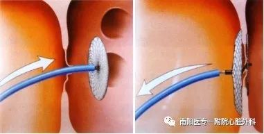 卵圆孔未闭封堵手术会脑血栓吗,心脏卵圆孔封堵术