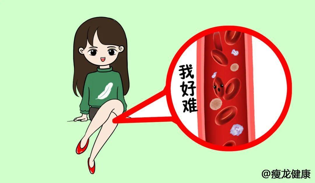 静脉曲张是什么？静脉曲张怎么预防？如何改善静脉曲张？