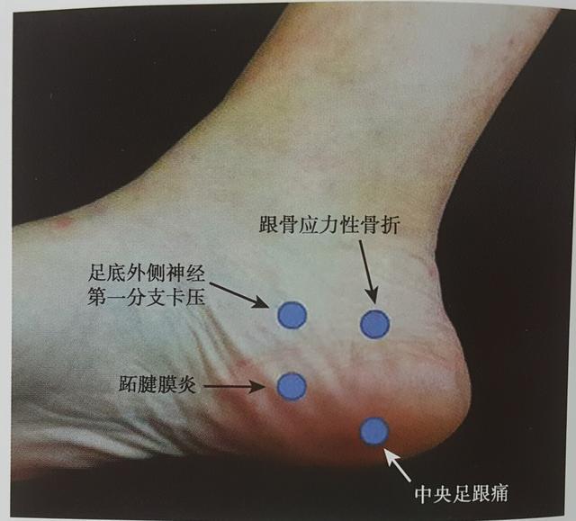 长跑中怎样避免足底筋膜炎,跑步引起的足底筋膜炎的康复训练