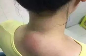 老中医跳起来治疗富贵包,老中医治富贵包的视频