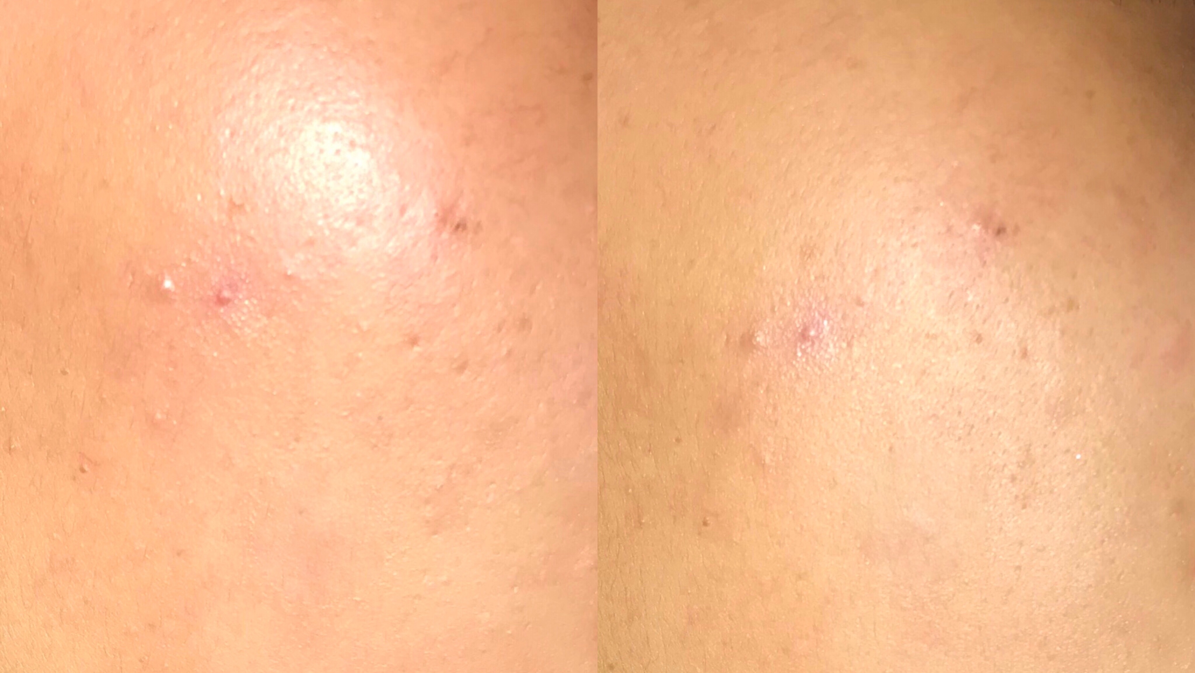 敏感肌*血丝红**终于有救了!敷尔佳新款绿膜,医美面膜王者不服不行