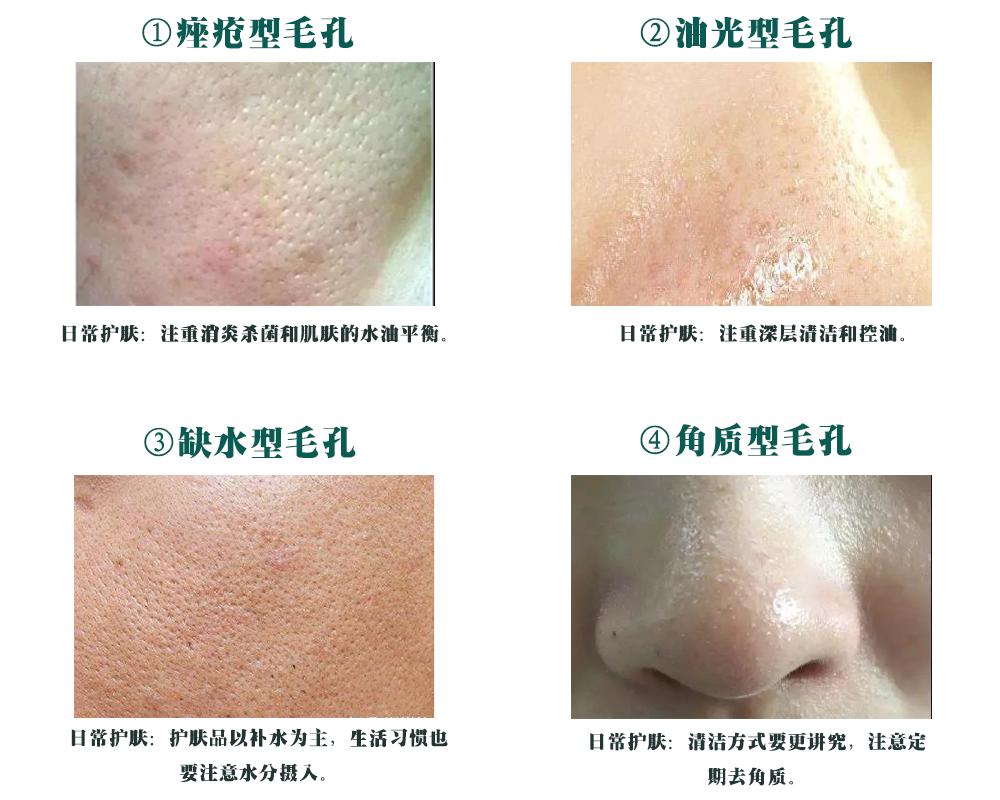 脸颊黑头毛孔粗大怎么去除最有效,改善毛孔黑头粗大的小窍门