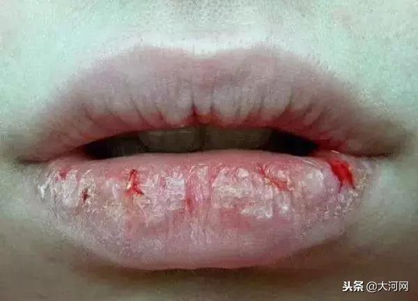 孕妇不慎挠破嘴唇竟长出血管瘤,孕妇嘴血管瘤