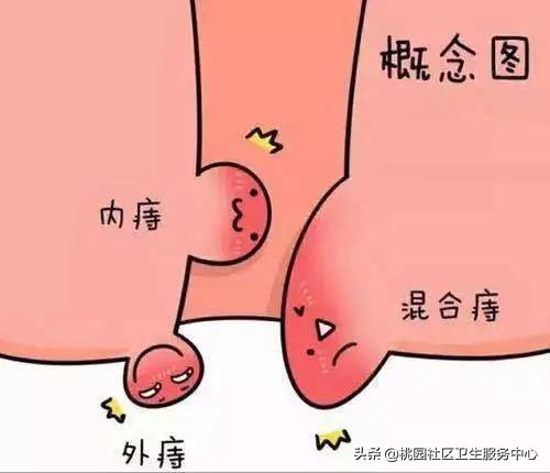 痔疮勿小视警惕直肠癌,痔疮要避免做什么动作